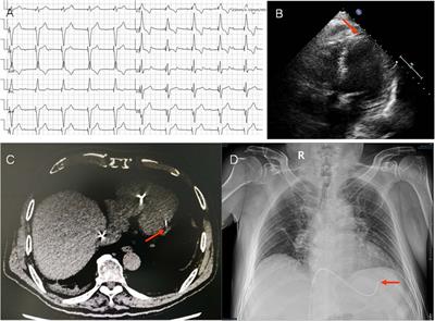 Case Report: A case suffered acute cerebral infarction after removal of temporary cardiac pacing lead which led to the perforation of interventricular septum